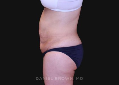 Tummy Tuck Before & After Patient #10825