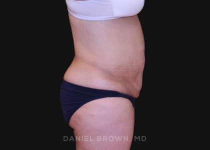 Tummy Tuck Before & After Patient #10825