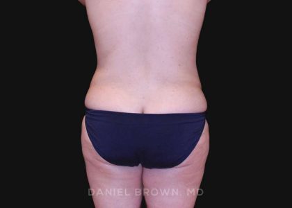 Tummy Tuck Before & After Patient #10825