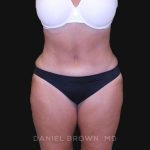 Tummy Tuck Before & After Patient #10838