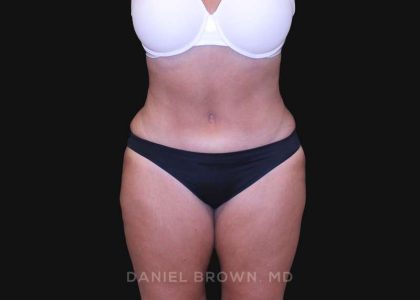 Tummy Tuck Before & After Patient #10838