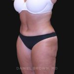 Tummy Tuck Before & After Patient #10838