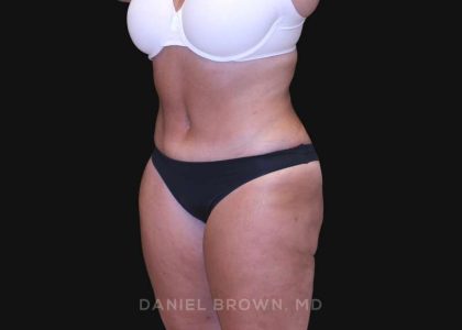 Tummy Tuck Before & After Patient #10838
