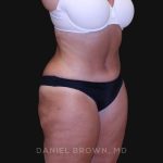 Tummy Tuck Before & After Patient #10838