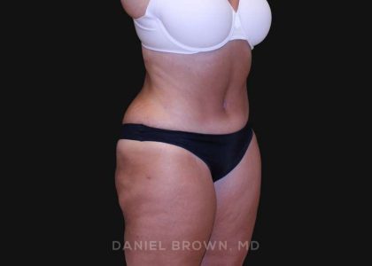 Tummy Tuck Before & After Patient #10838