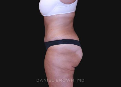 Tummy Tuck Before & After Patient #10838
