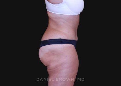 Tummy Tuck Before & After Patient #10838