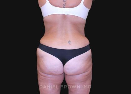 Tummy Tuck Before & After Patient #10838