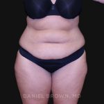 Tummy Tuck Before & After Patient #10838