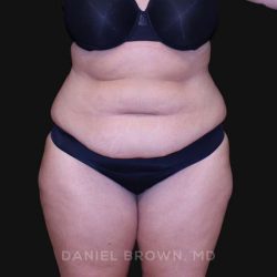 Tummy Tuck Before & After Patient #10838