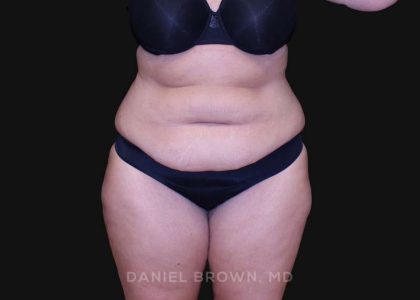 Tummy Tuck Before & After Patient #10838