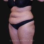 Tummy Tuck Before & After Patient #10838