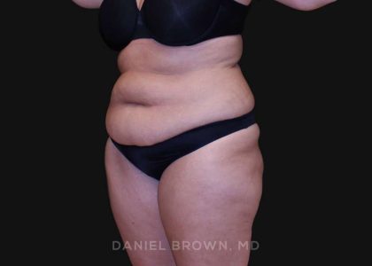 Tummy Tuck Before & After Patient #10838