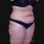 Tummy Tuck Before & After Patient #10838