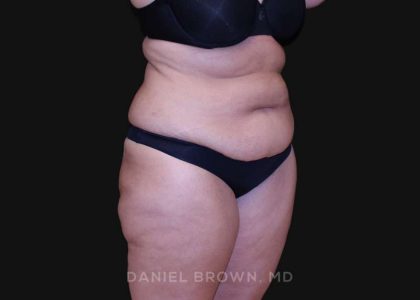 Tummy Tuck Before & After Patient #10838