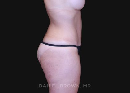 Tummy Tuck Before & After Patient #10851