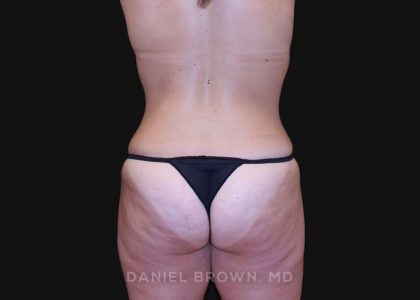Tummy Tuck Before & After Patient #10851