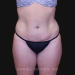 Tummy Tuck Before & After Patient #10851