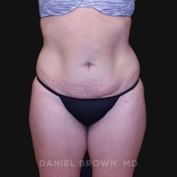 Tummy Tuck Before & After Patient #10851