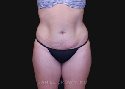 Tummy Tuck Before & After Patient #10851