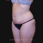 Tummy Tuck Before & After Patient #10851