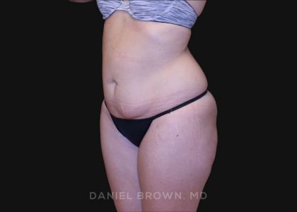 Tummy Tuck Before & After Patient #10851