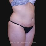 Tummy Tuck Before & After Patient #10851