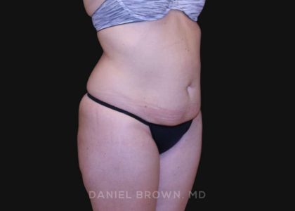 Tummy Tuck Before & After Patient #10851