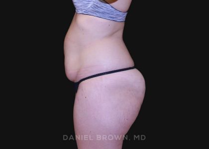 Tummy Tuck Before & After Patient #10851
