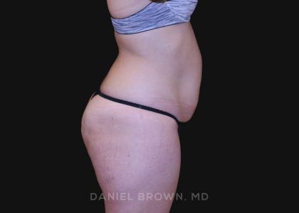 Tummy Tuck Before & After Patient #10851
