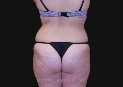 Tummy Tuck Before & After Patient #10851