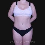 Tummy Tuck Before & After Patient #10864