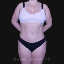 Tummy Tuck Before & After Patient #10864