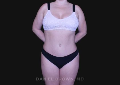 Tummy Tuck Before & After Patient #10864