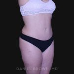 Tummy Tuck Before & After Patient #10864