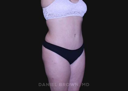 Tummy Tuck Before & After Patient #10864