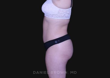 Tummy Tuck Before & After Patient #10864
