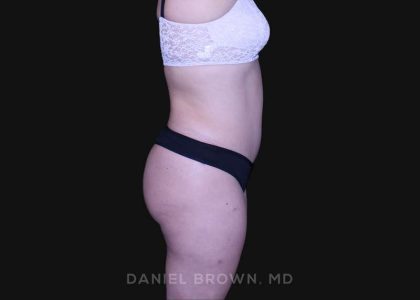 Tummy Tuck Before & After Patient #10864
