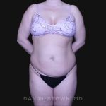 Tummy Tuck Before & After Patient #10864