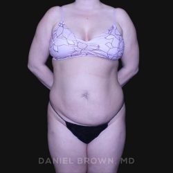 Tummy Tuck Before & After Patient #10864