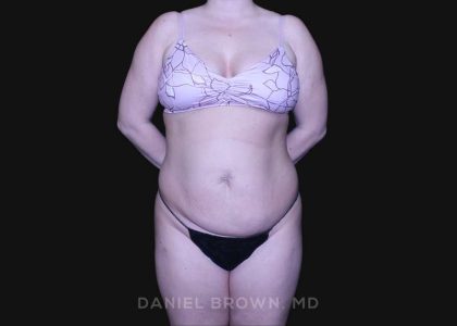 Tummy Tuck Before & After Patient #10864