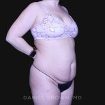 Tummy Tuck Before & After Patient #10864