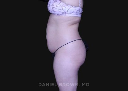 Tummy Tuck Before & After Patient #10864