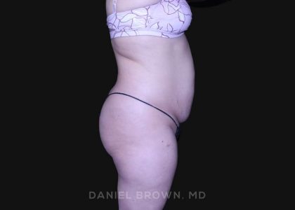 Tummy Tuck Before & After Patient #10864