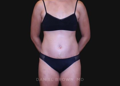 Tummy Tuck Before & After Patient #10877