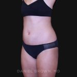 Tummy Tuck Before & After Patient #10877