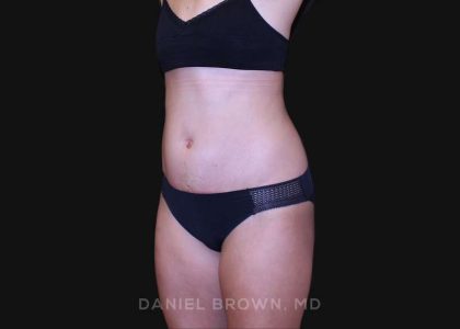 Tummy Tuck Before & After Patient #10877