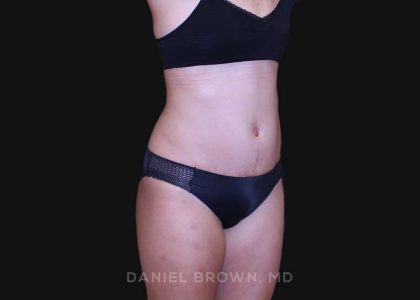 Tummy Tuck Before & After Patient #10877