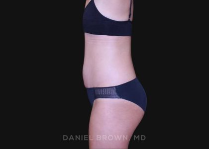 Tummy Tuck Before & After Patient #10877