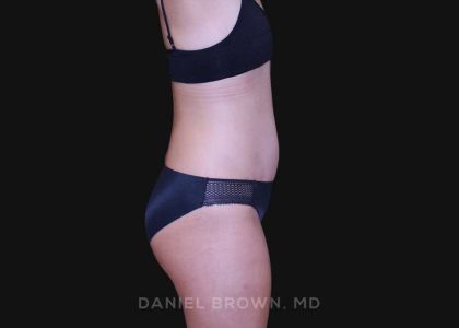 Tummy Tuck Before & After Patient #10877